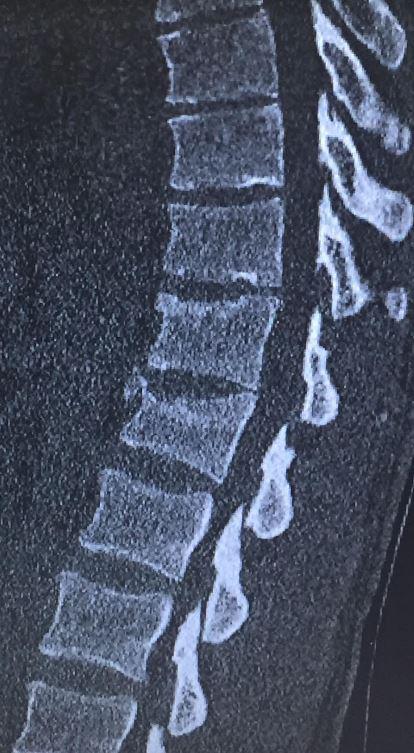  The young man broke his spine - with an xray showing the damage that he suffered from the plane crash