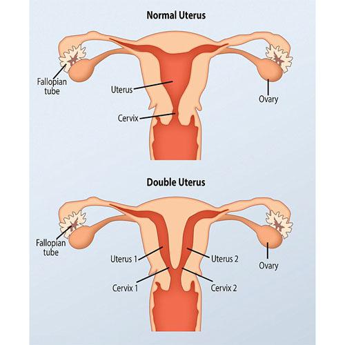  Because the uterus failed to form properly, two separate ones within the same body will occur