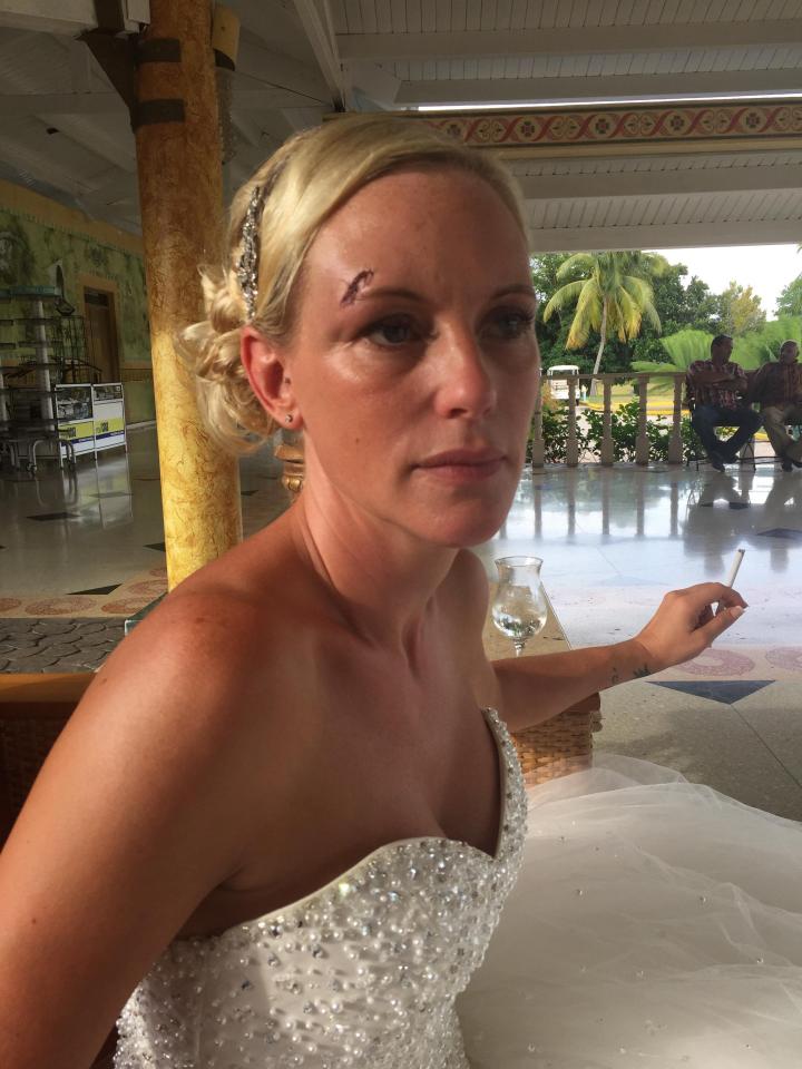 Sarah was left with a gash to her face on her wedding day