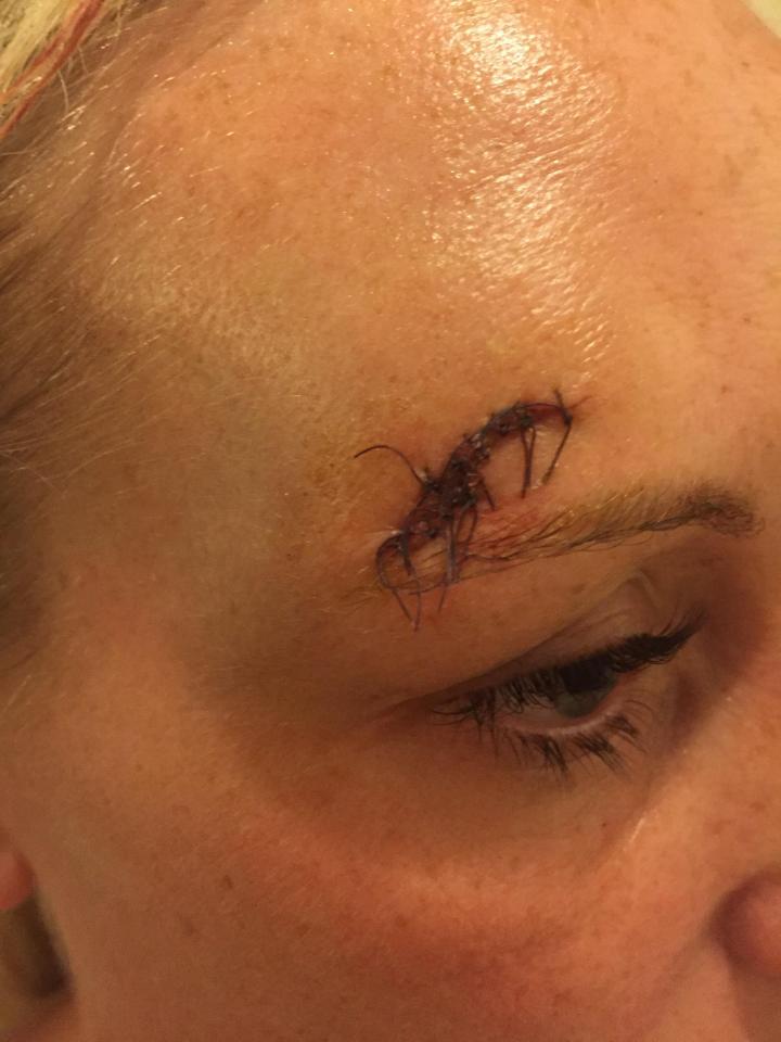 The bride suffered a serious gash above her right eye