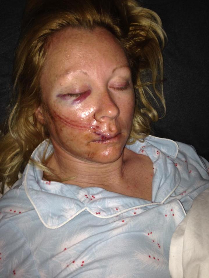  Louise Timbrell, 42, was left with horrific facial injuries after a skiing accident