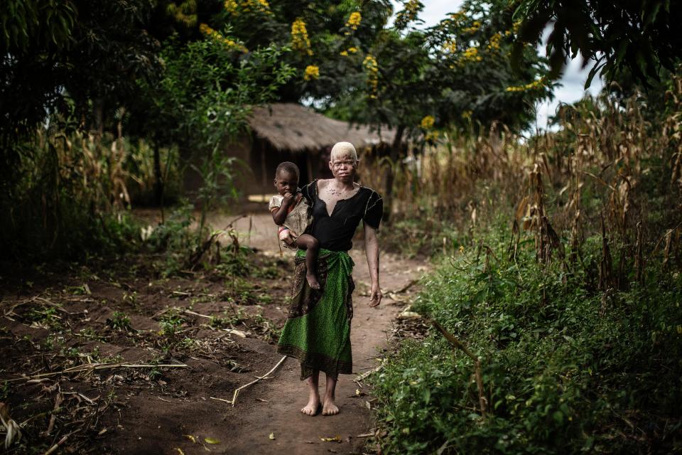  On UN chief even warned that Malawi's albinos face extinction of the problem is not addressed