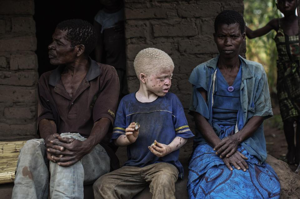  Such is danger for an albino in East Africa that fewer than two per cent live beyond 40