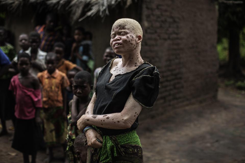  Such is the threat to albinos that a special centre has been set up where they can be protected under armed guard