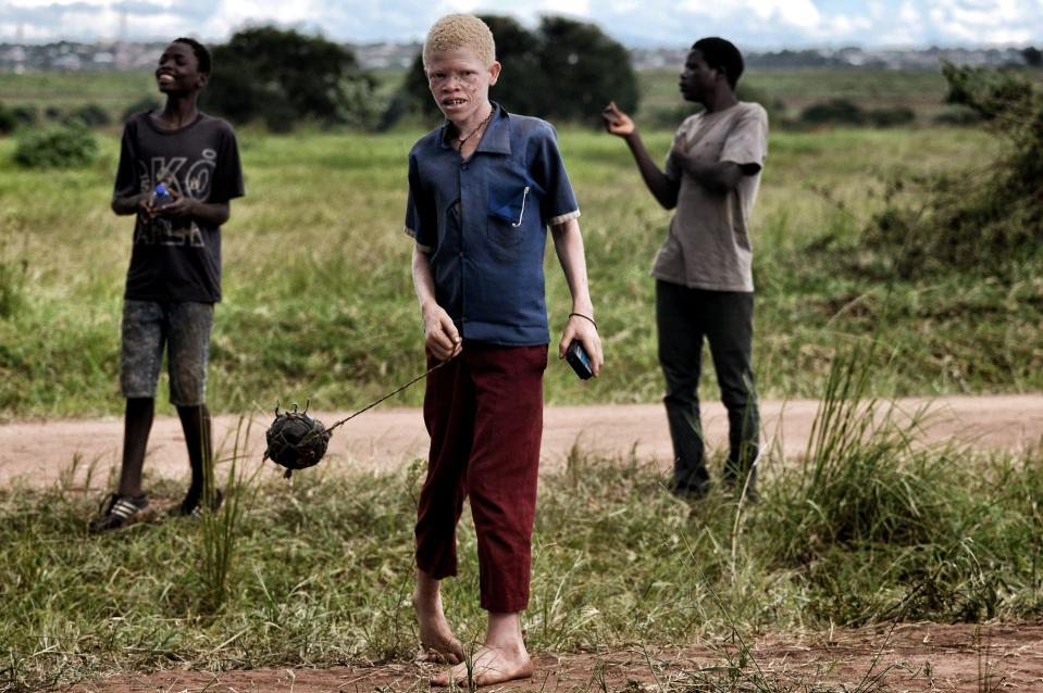  Dozens of albinos have been attacked in Malawai in just two years, with several killed and their body parts used for witchcraft potions