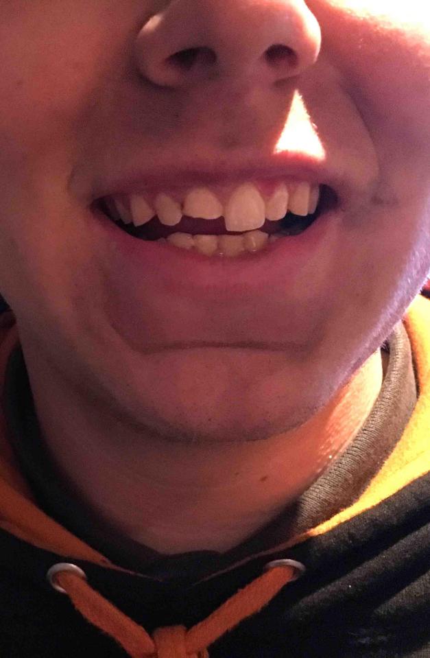  The 18-year-old lost half a tooth as he was kicked in the face