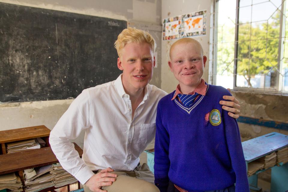  Dr Oscar Duke, who stars in Born Too White and 24 Hours in A&E with another albinism sufferer