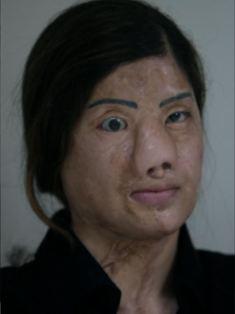 Before Dr Shahmalak transplanted her hair, Kanwal used to draw her eyebrows on with a black marker