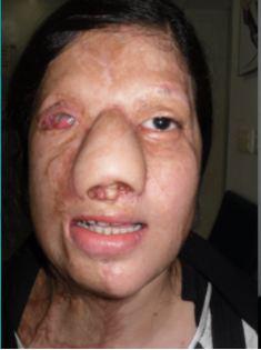 Doctors completely rebuilt her nose using tissue from her thigh