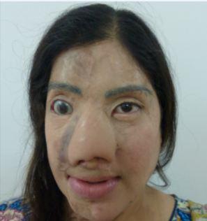 10 years after the horrific attack, Kanwal's face has completely transformed thanks to the tireless work of surgeons