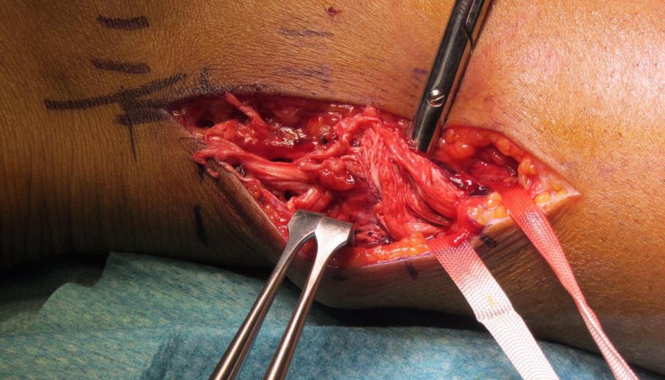  The state of David Haye's Achilles injury can be seen from this shot during surgery