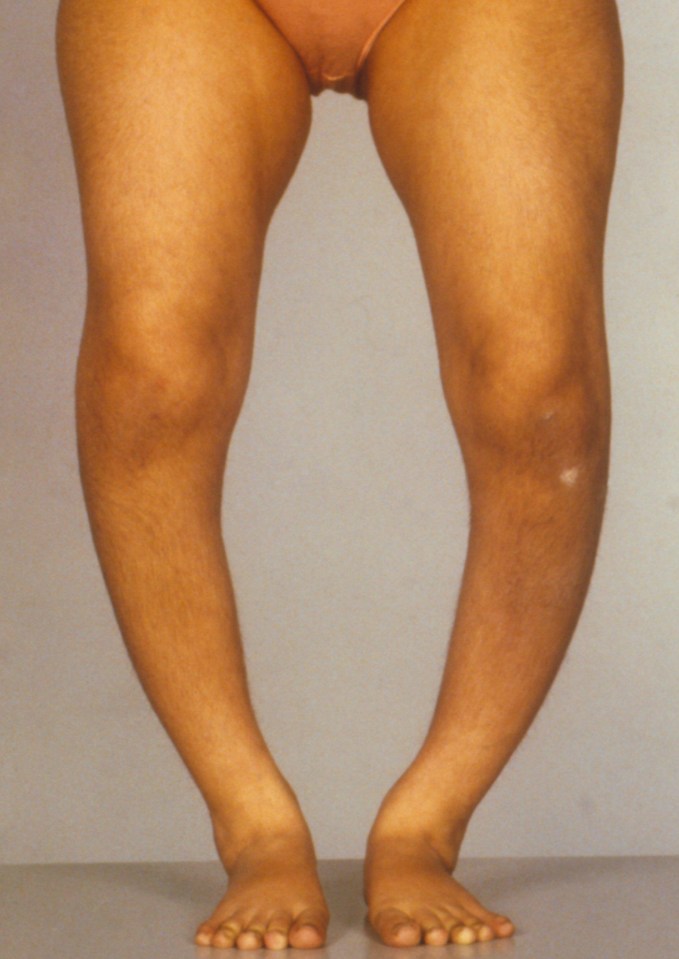 Rickets is caused by a Vitamin D deficiency due to lack of sunshine or poor diet