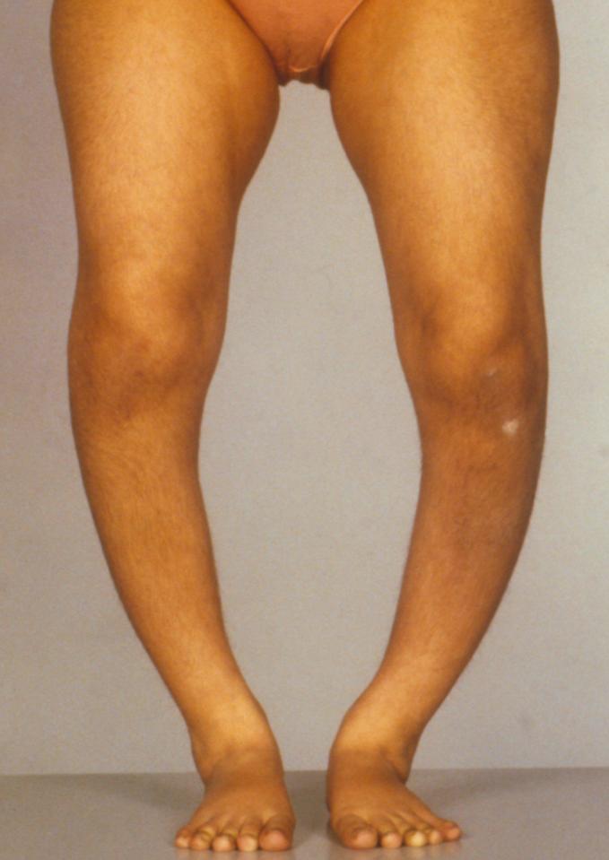  Rickets is caused by a Vitamin D deficiency due to lack of sunshine or poor diet