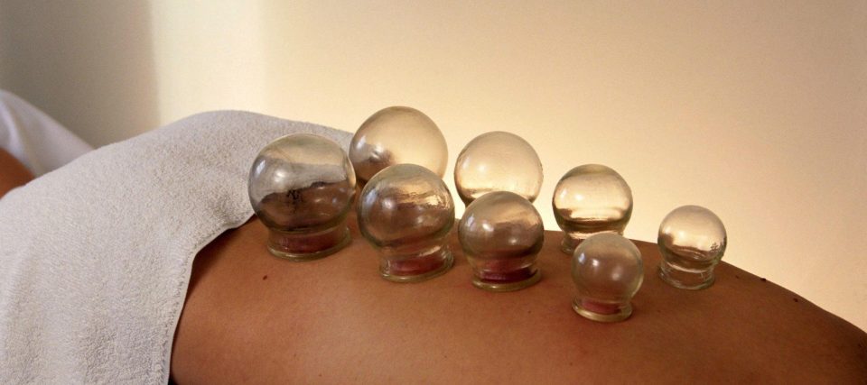  Cupping has only become popular in recent years - but it can be traced back to ancient Chinese and Egyptian days