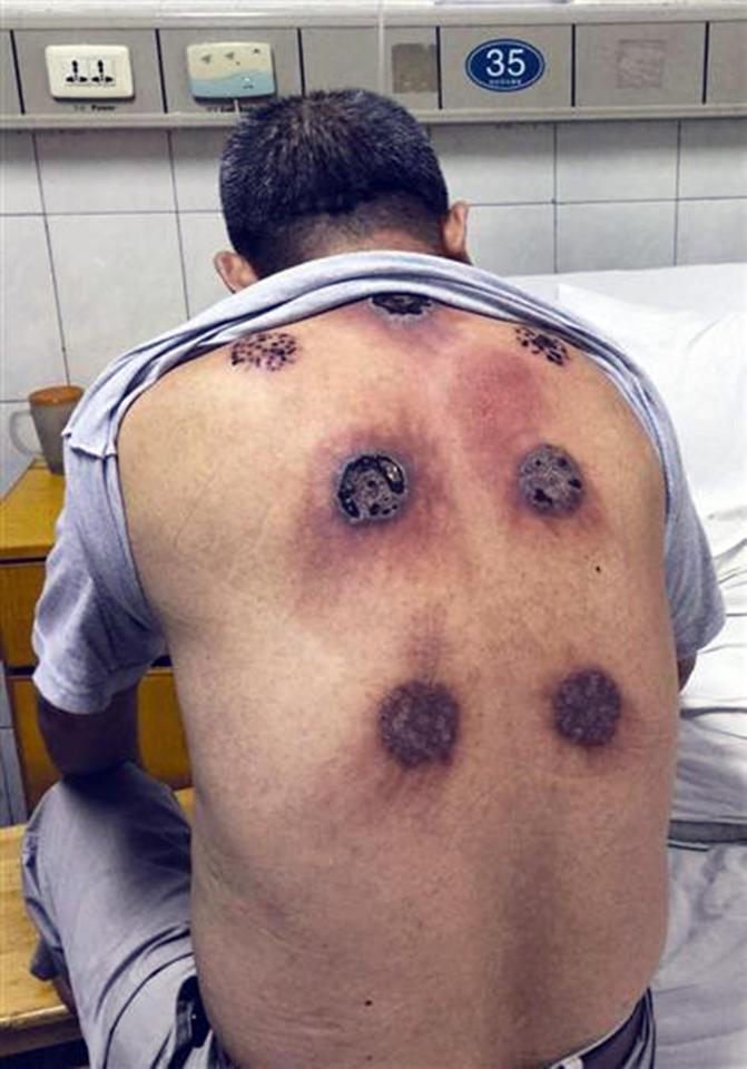  Lin Lin was left with painful burns and a skin infection from cupping