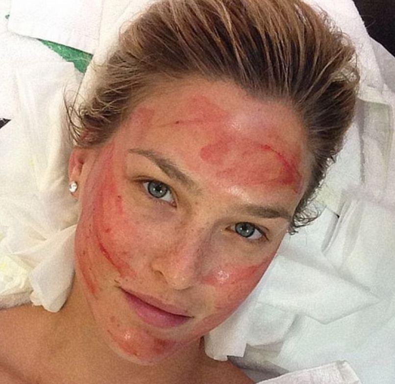  Model Bar Rafaeli has also indulged in a vampire facial