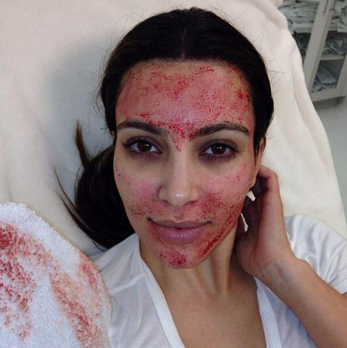  Kim Kardashian made vampire facials famous after posting this picture on Twitter