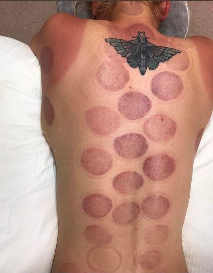  Cupping leaves tell-tale red marks on the client's back