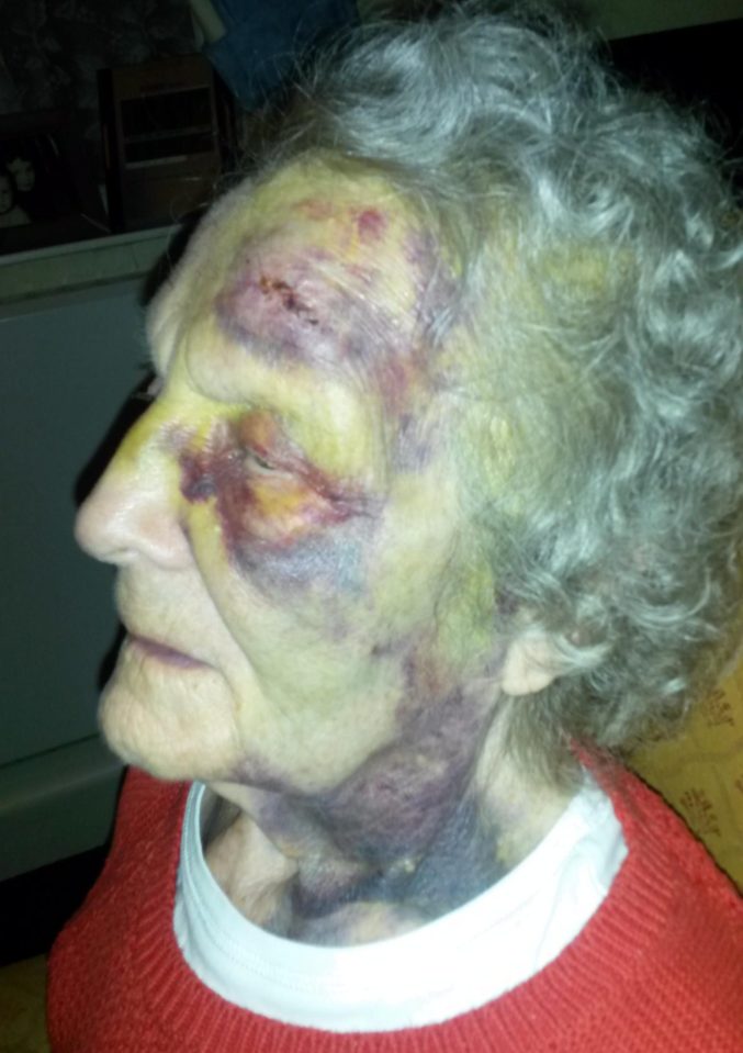  Joyce Wood, 90, was left waiting for an ambulance for five hours after hurting her face in a fall