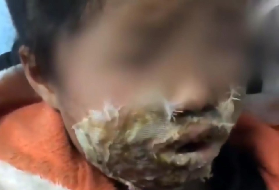 A four-year-old girl has suffered second-degree burns on her face after her dad’s months-old Samsung phone exploded next to her while she slept