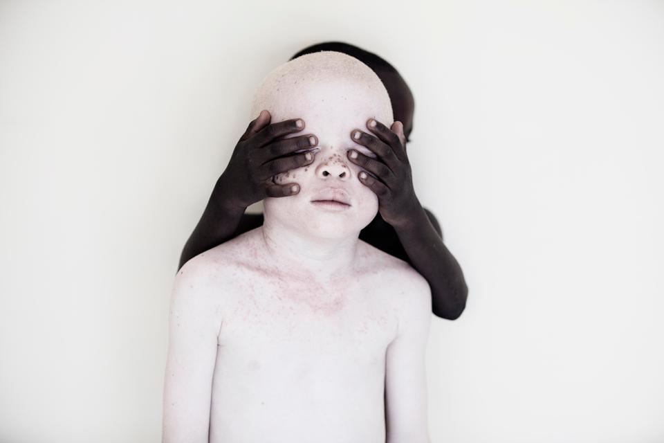  Albino children are often disowned by their parents due to local superstitions