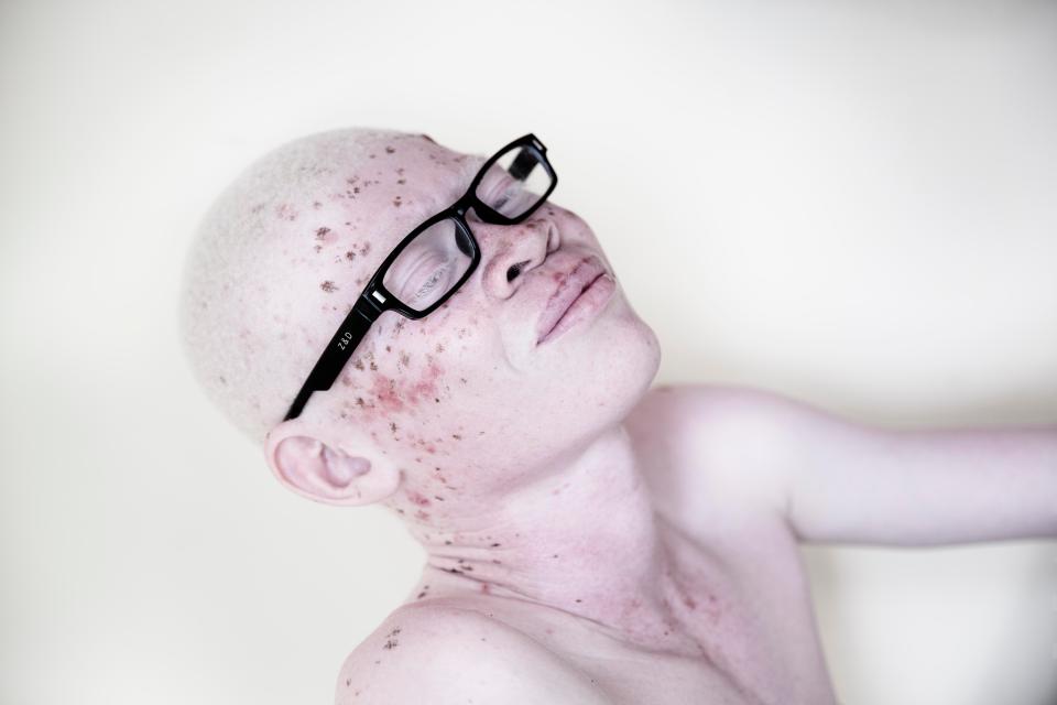  An albino boy with glasses poses for a photograph