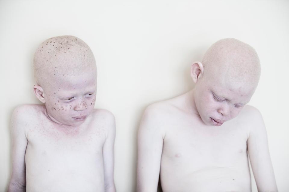  Despite widespread scientific understanding of albinism, children are still killed due to local superstitions