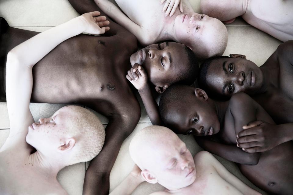  A tangle of children - some black and some with albinism - come together to raise awareness of the plight of albinism in Dar es Salaam