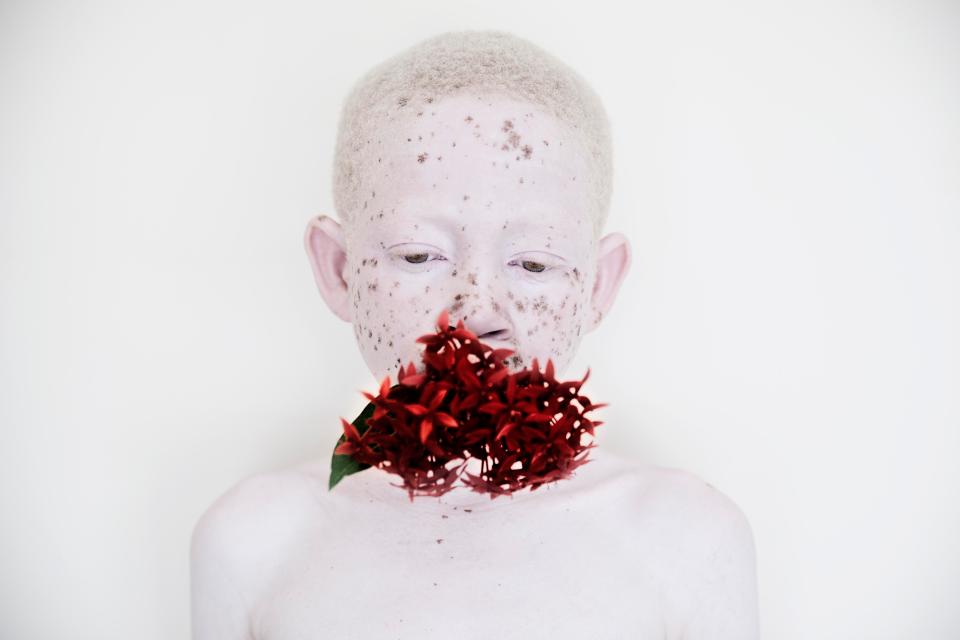  An albino boy poses for a tender photograph holding a flower in his mouth