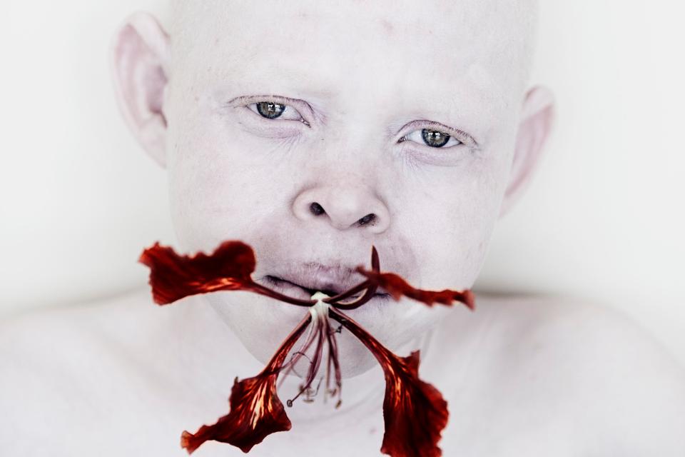  A boy with albinism poses for a portrait with a flower in his mouth