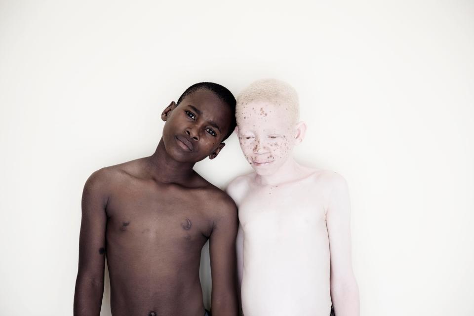  Two young boys, one of which has albinism, pose for this striking photograph