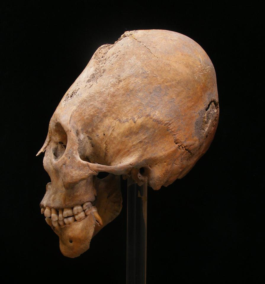  Cambridge University has analysed skulls from Hun gravesites which suggest they didn't tear apart the Roman Empire as viciously as initially thought