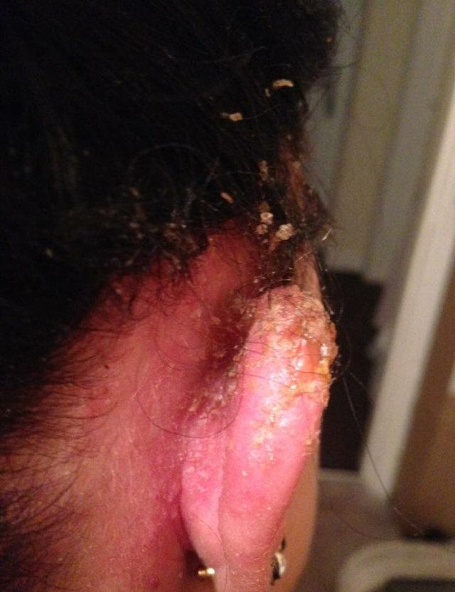 Within 12 hours of dying her hair, she had bubbly skin, red marks, and burns around her ears