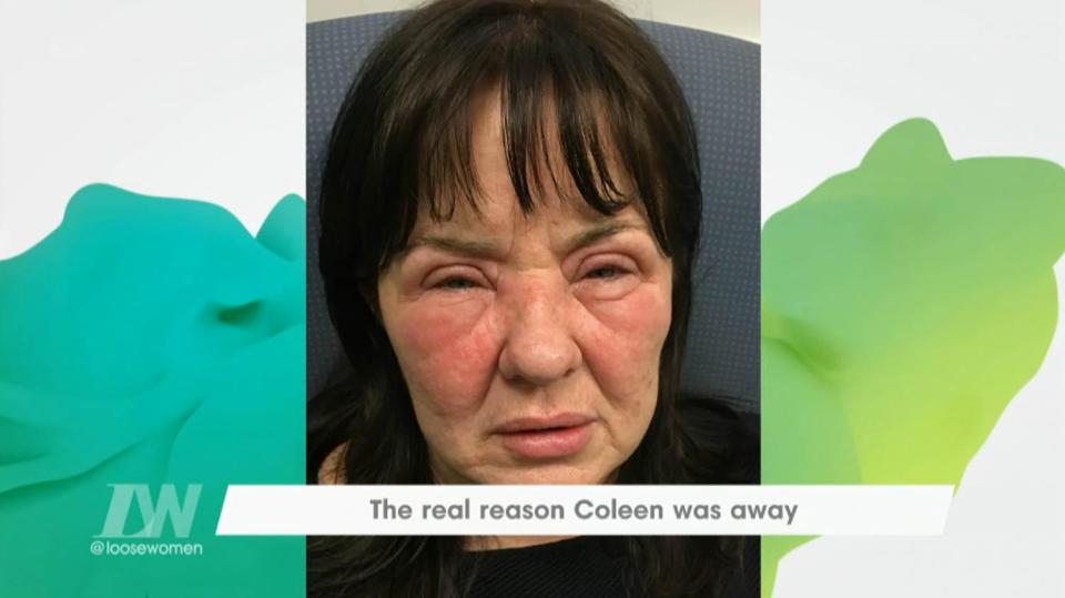  The stress of the situation also saw Coleen suffer a painful allergic reaction