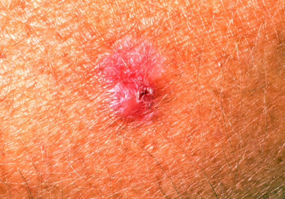  Basal cell carcinoma is is a type of non-melanoma skin cancer that develops in the outer most layer of skin