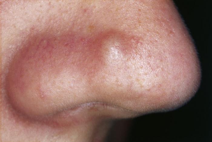  Papules are like pimples, but are hard to touch and do not have a pus filled top