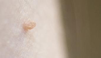  Skin tags grow due to excess collagen but are harmless and considered more of a cosmetic problem