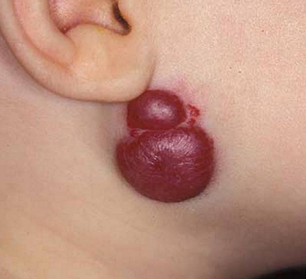  A hemangioma can occur anywhere on the body and is caused by a cluster of blood vessels