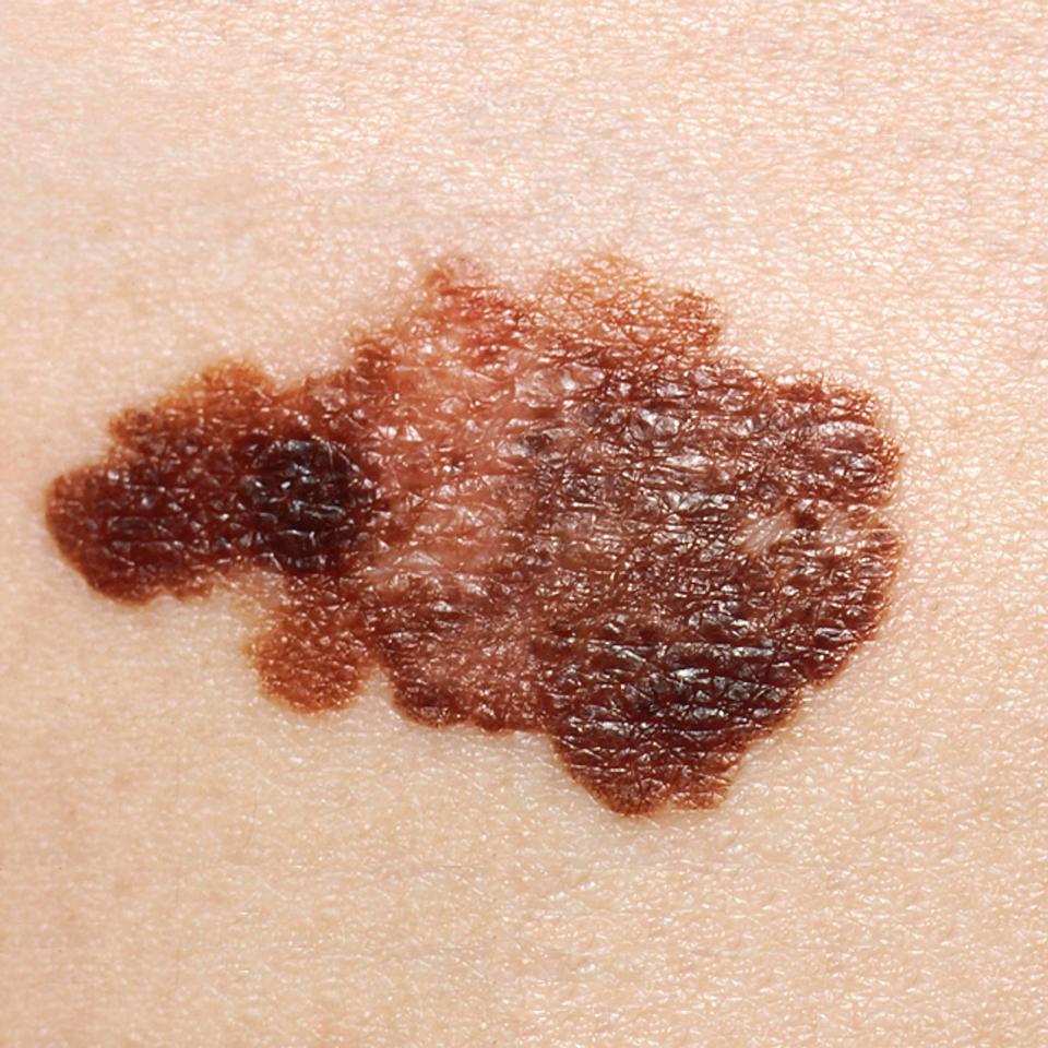  Melanoma is the most serious type of skin cancer and can affect the lymph nodes and blood vessels