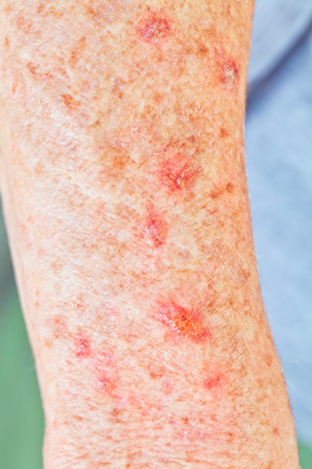  Actinic keratosis usually appears as dry, scaly patches and if left untreated can lead to cancer