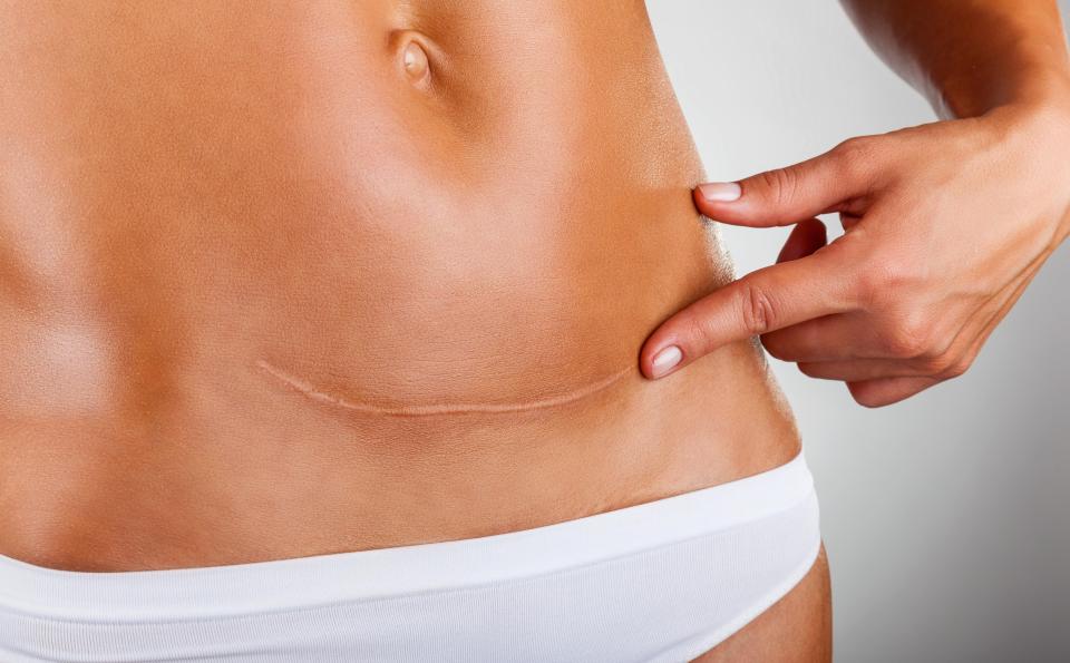  The surgery often leaves behind a 10-20cm scar on the body, which fades with time