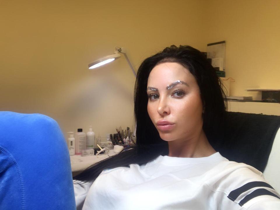  She is forking out £1,000 for acid brow peel corrective surgery