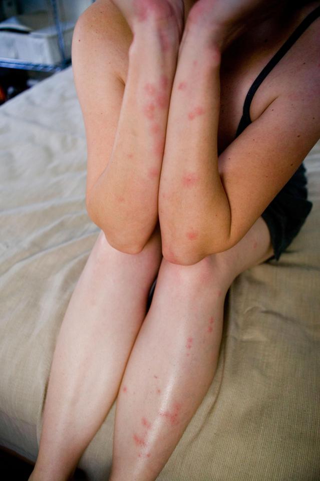  People can be left with red bites if their rooms are infected with bed bugs