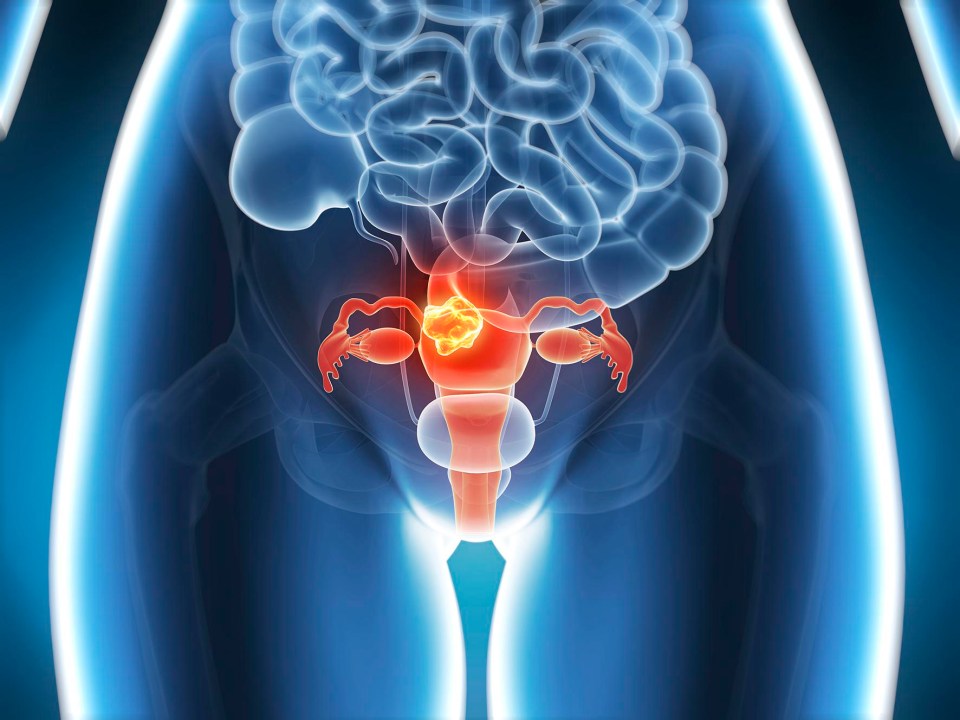 Heavy periods can, in extreme cases, be a warning sign of womb cancer