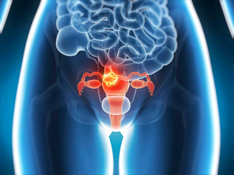  Heavy periods can, in extreme cases, be a warning sign of womb cancer