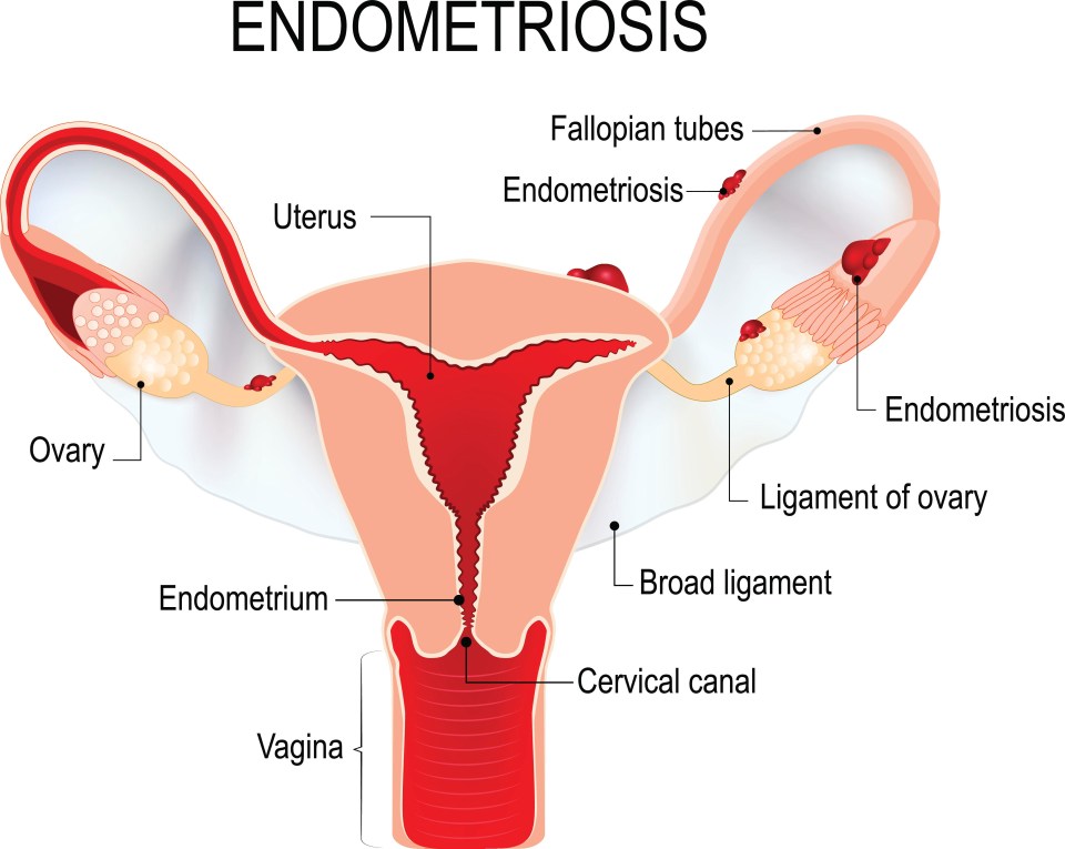 Endometriosis is a painful condition that causes the lining of the womb to behave abnormally and grow outside the womb