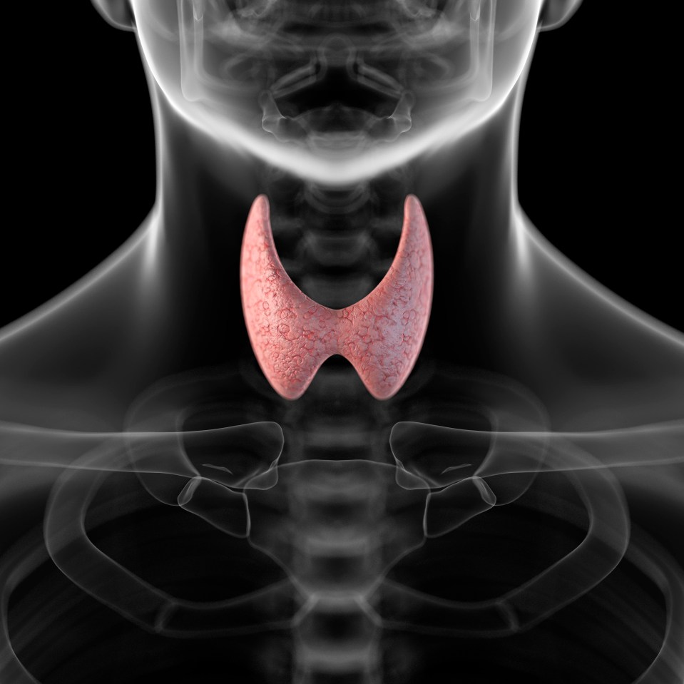 An overactive thyroid gland can cause your period to stop altogether