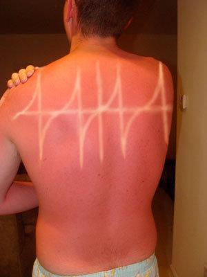 Not only has this sunseeker completely burnt his back, he’s also failed to get an even tan