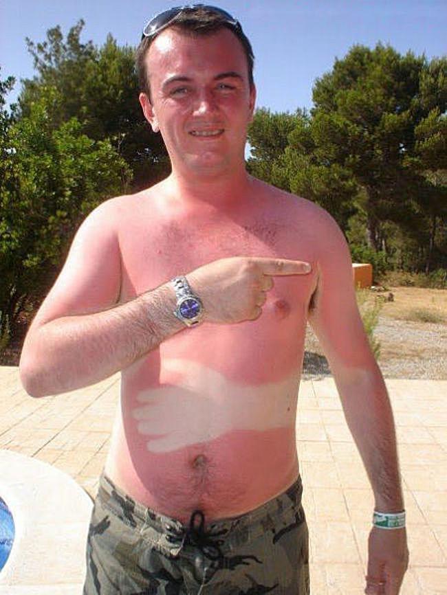 Falling asleep in the sun with his hand crossed around his body created this hilarious – and painful looking – tanning fail