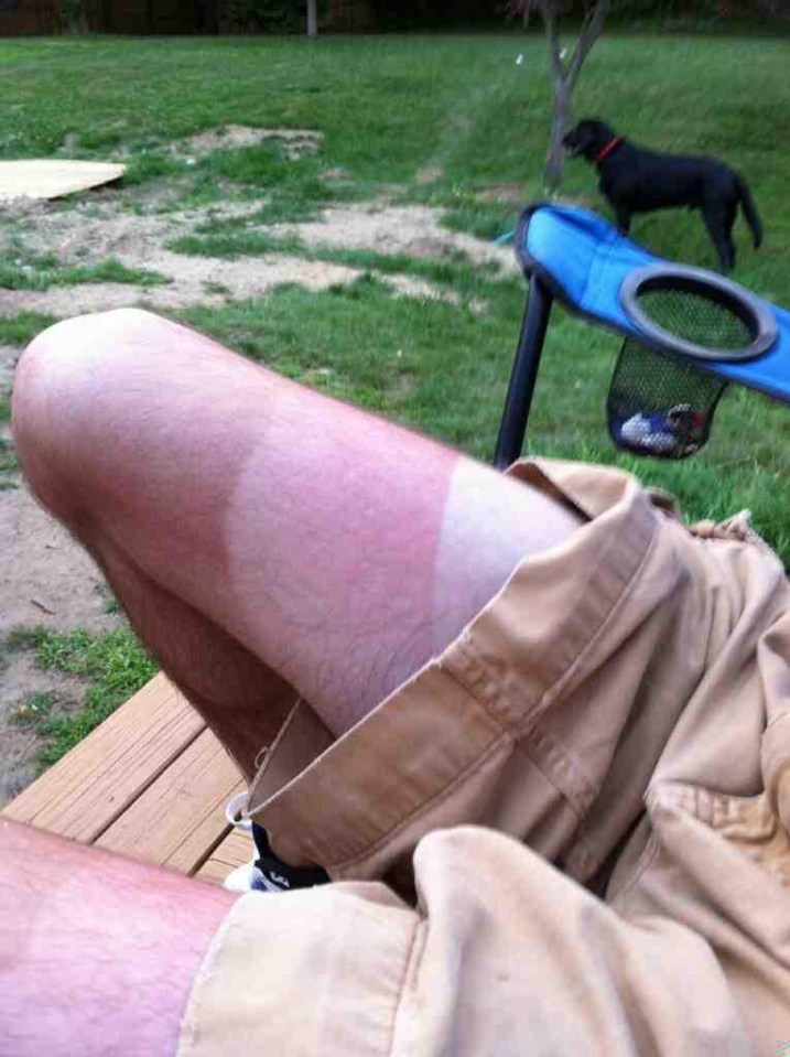 This bloke ended up getting a tan that resembled a Neapolitan ice cream when he failed to slap on some SPF